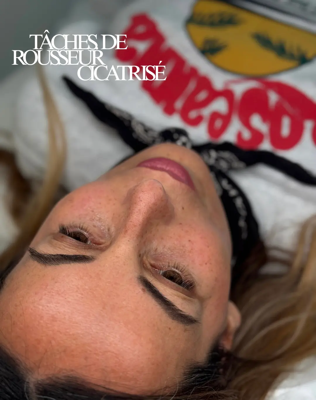 Taches de rousseur