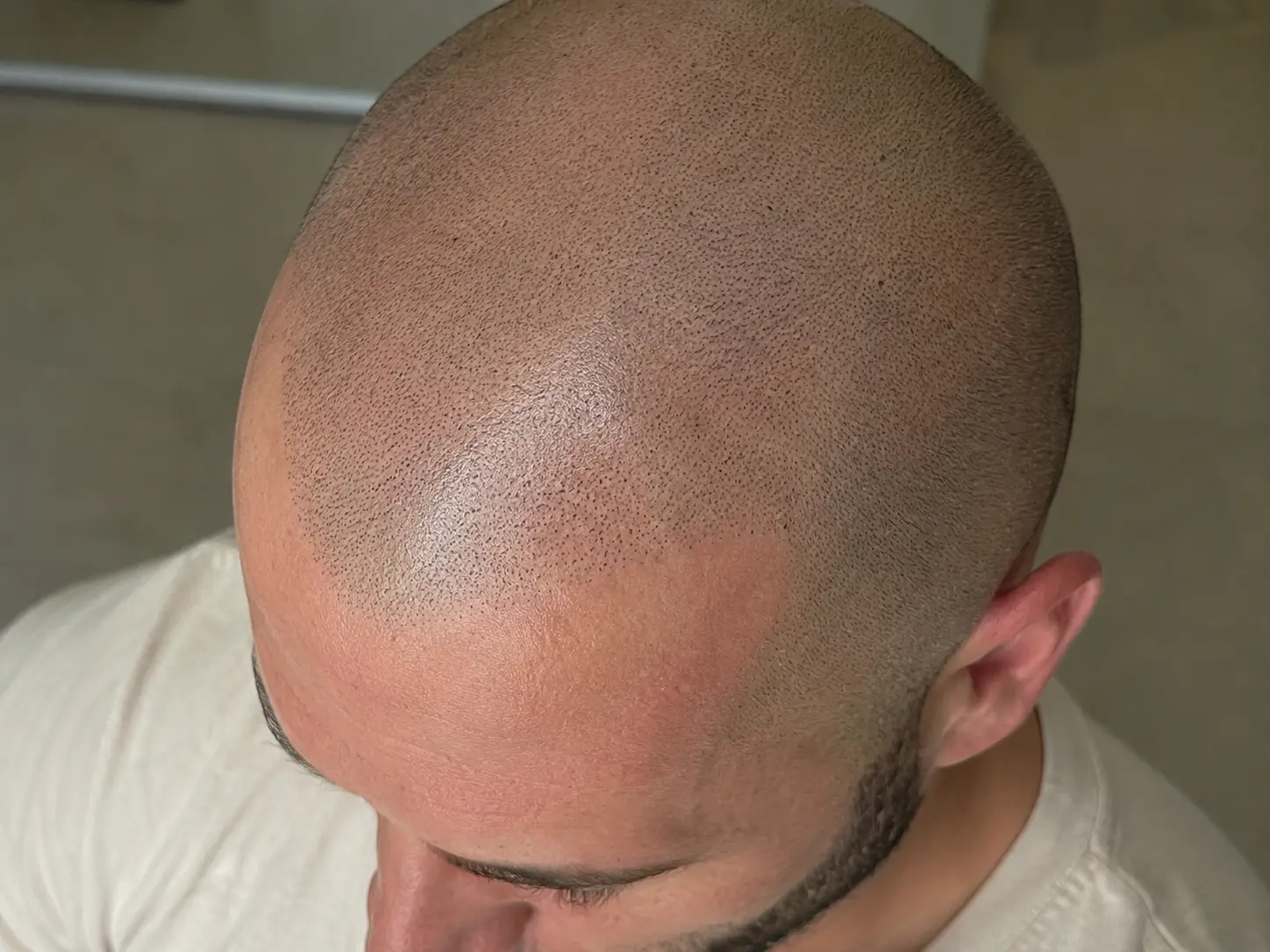 Tricopigmentation
